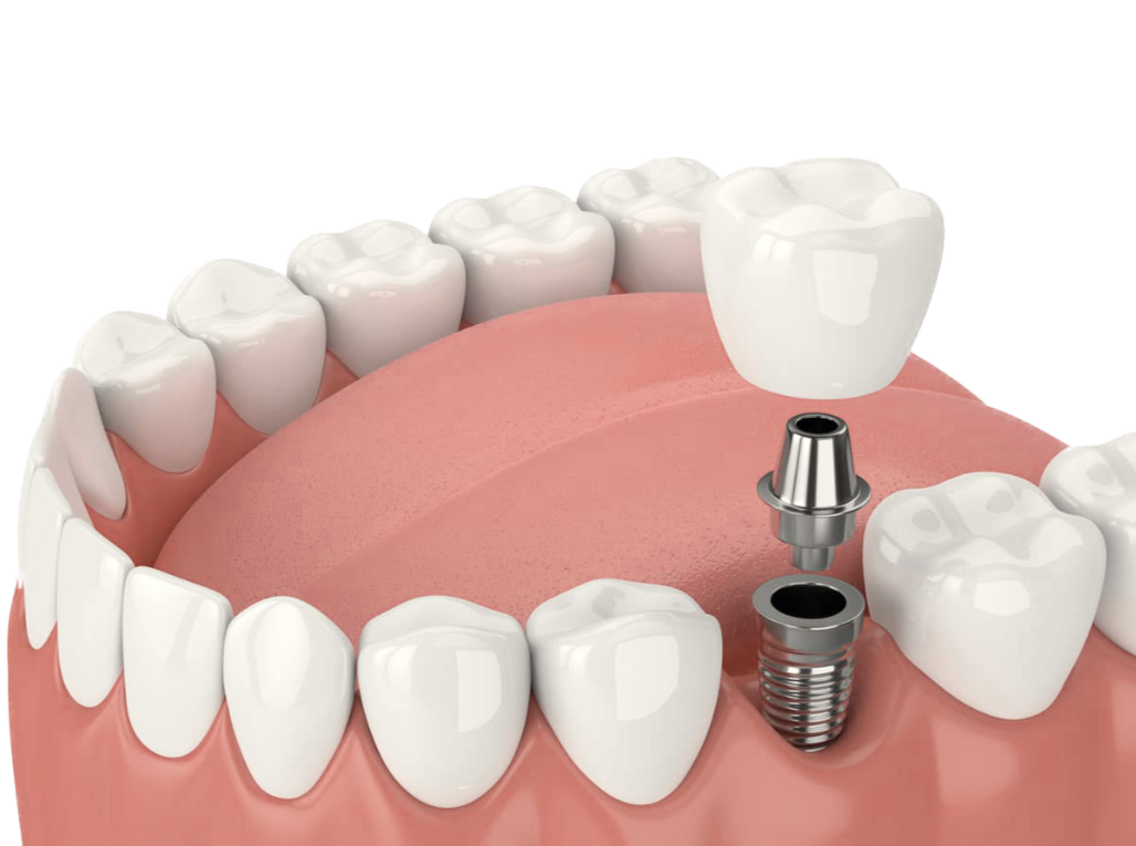 How To Lose Money With definition of dental prosthesis